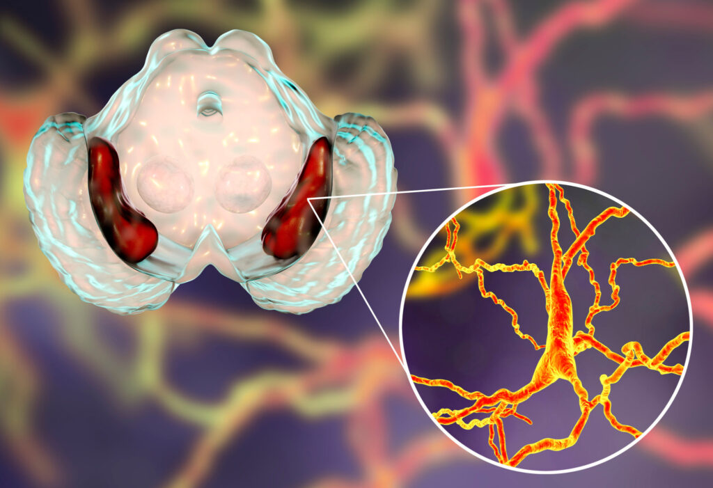 What happens inside the brain during Parkinson's disease?